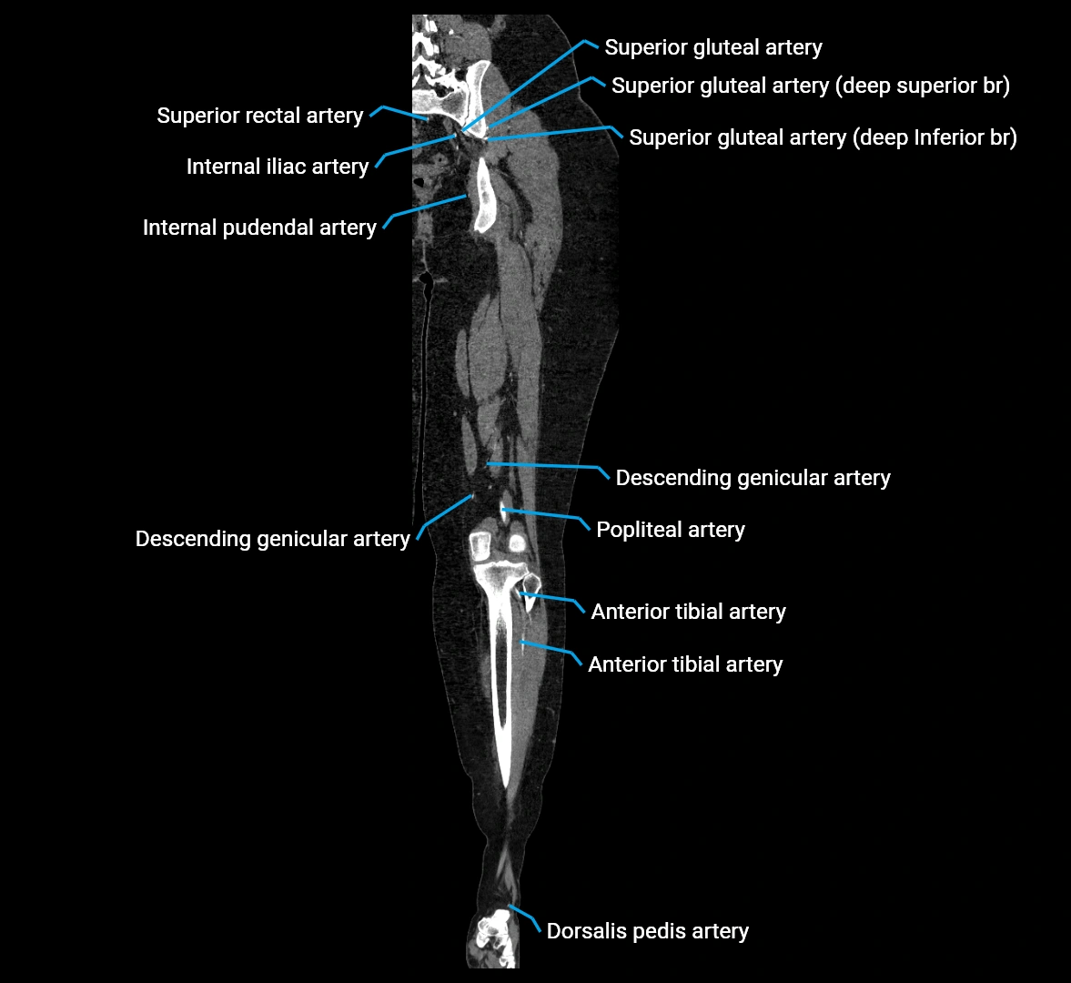 CTA lower limb coronal cross sectional anatomy labelled image _55 (2).webp